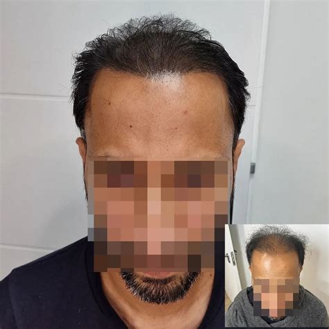 Scalp Micropigmentation (Make Your Hair Look Fuller) .